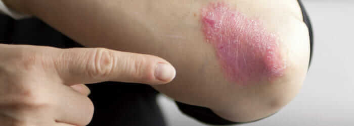 Eczema on elbow. Separation conflict.