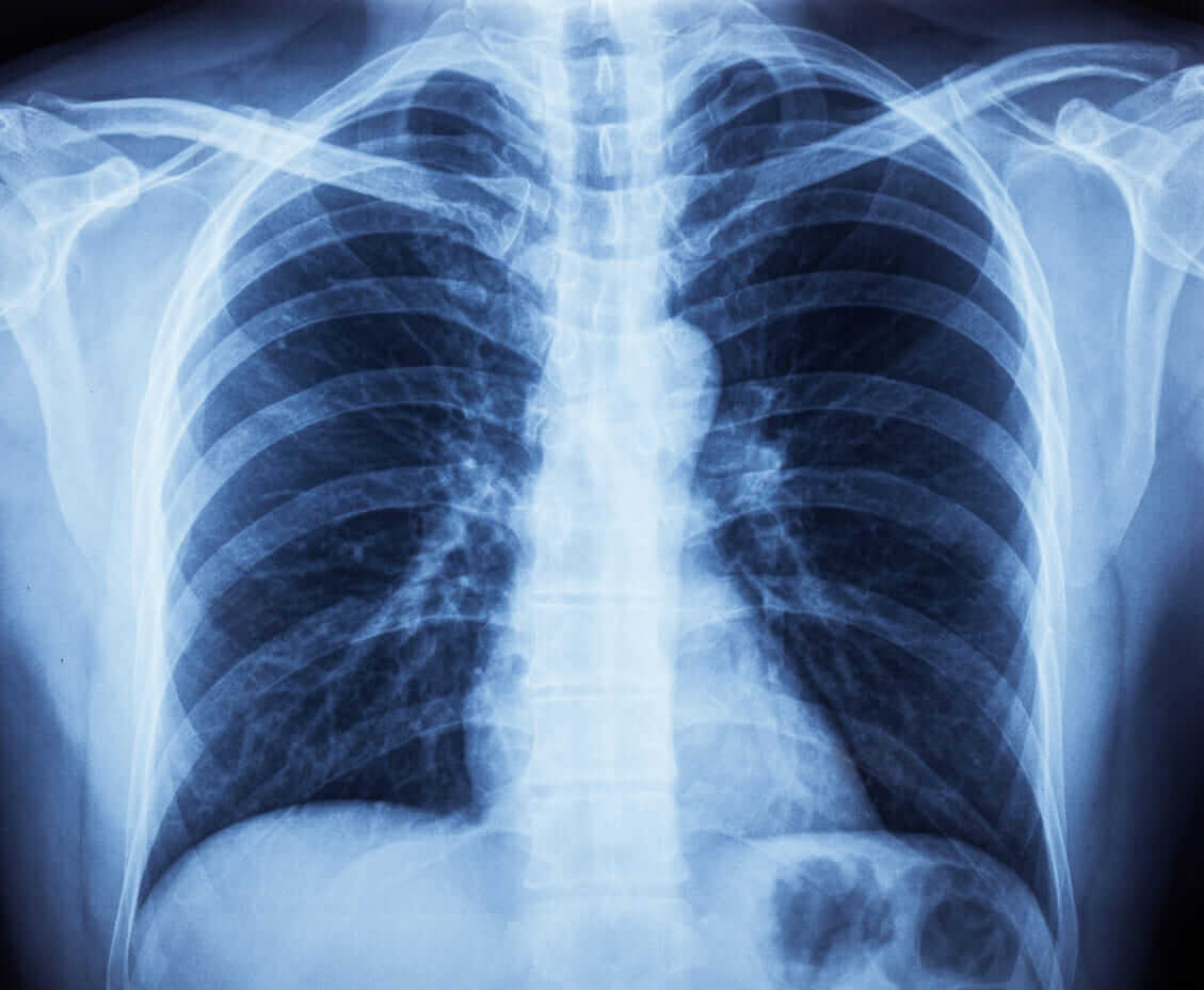 Pneumonia - German New Medicine Online Seminars